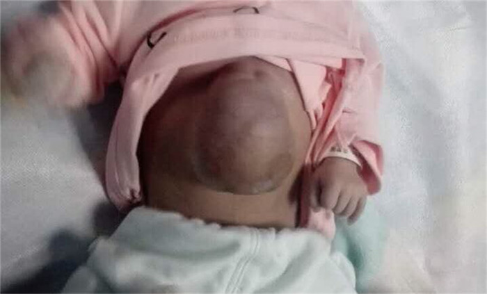 省妇幼成功为一“外心”女婴实施手术