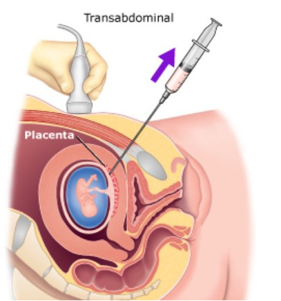 抽取胎盘内少量的绒毛组织进行实验室相关检查