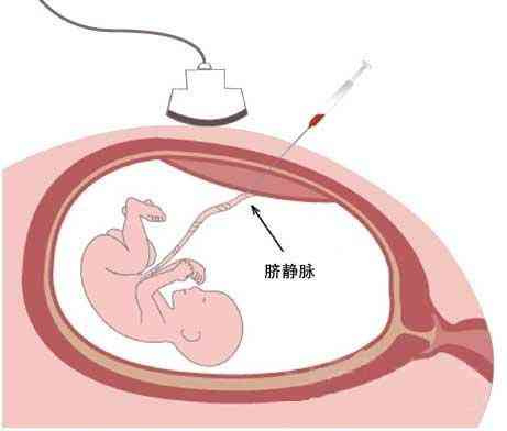 羊膜腔及脐静脉的穿刺针均很细,穿刺时均与平时打针抽血的疼痛程度