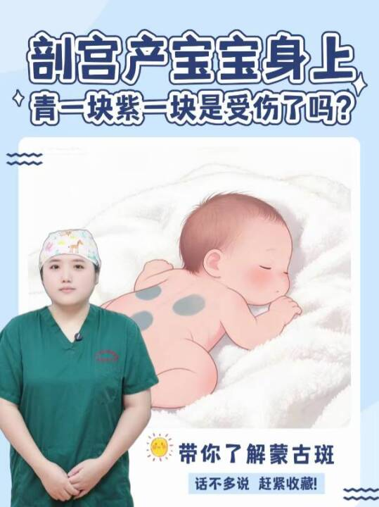  剖宫产宝宝身上青一块紫一块是受伤了吗？