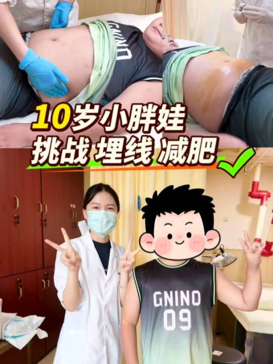 10岁小胖娃挑战埋线减肥